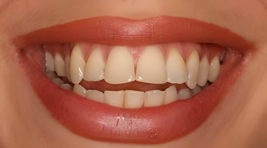 Before smile makeover treatment