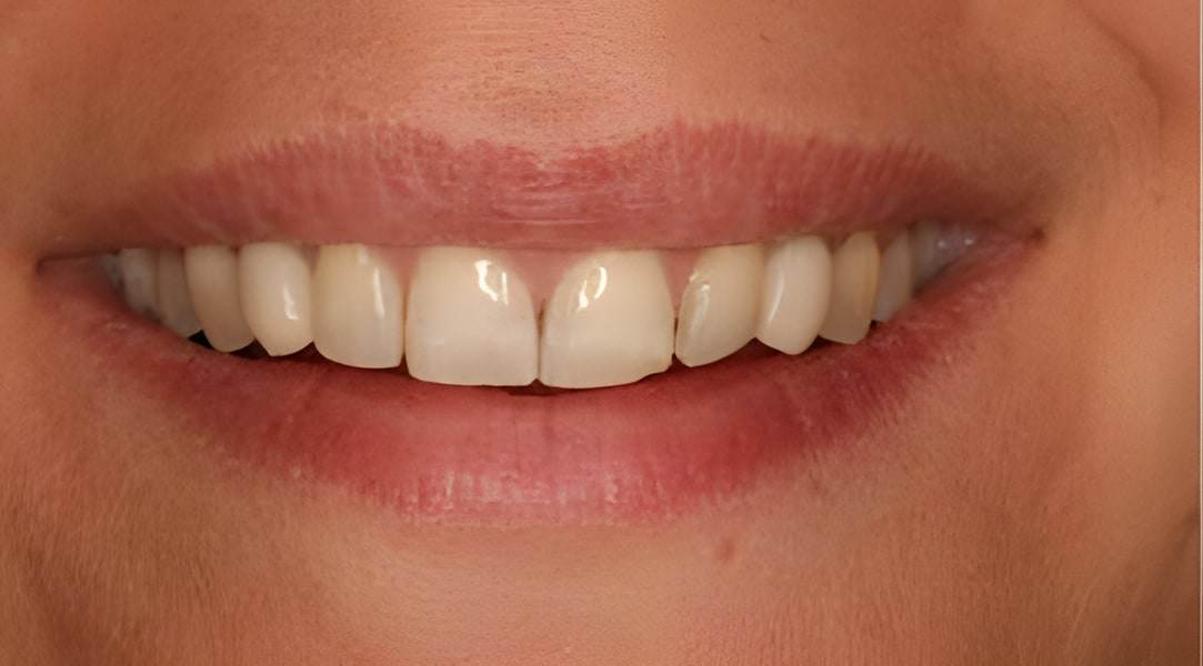 After dental implants treatment