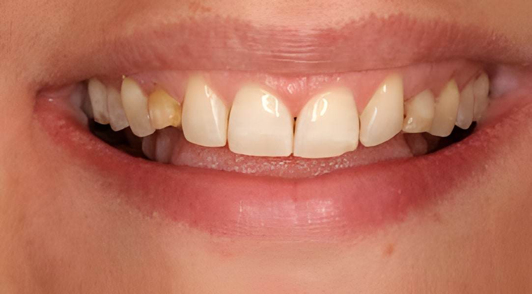 Before dental implants treatment