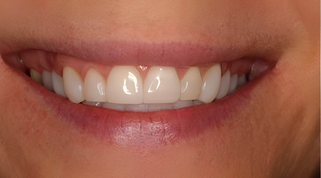 After cosmetic bonding treatment