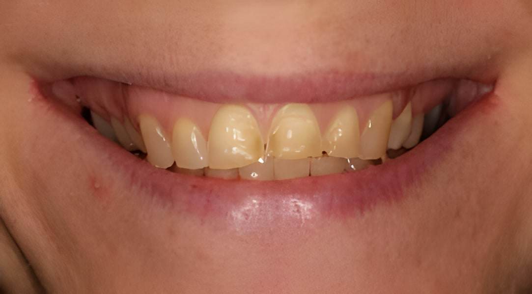 Before cosmetic bonding treatment